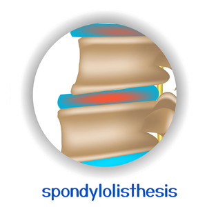 image of New Roads spondylolisthesis