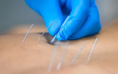 Dry Needling: A Modern Solution for Pain Relief and Muscle Tension