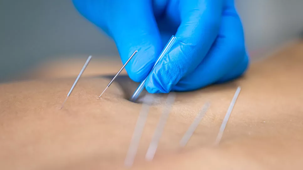 Dry Needling: A Modern Solution for Pain Relief and Muscle Tension